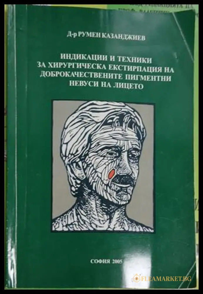 Индикации и техники за хирургическа екстирпация на доброкачествените пигментни невуси на лицето — Румен Казанджиев