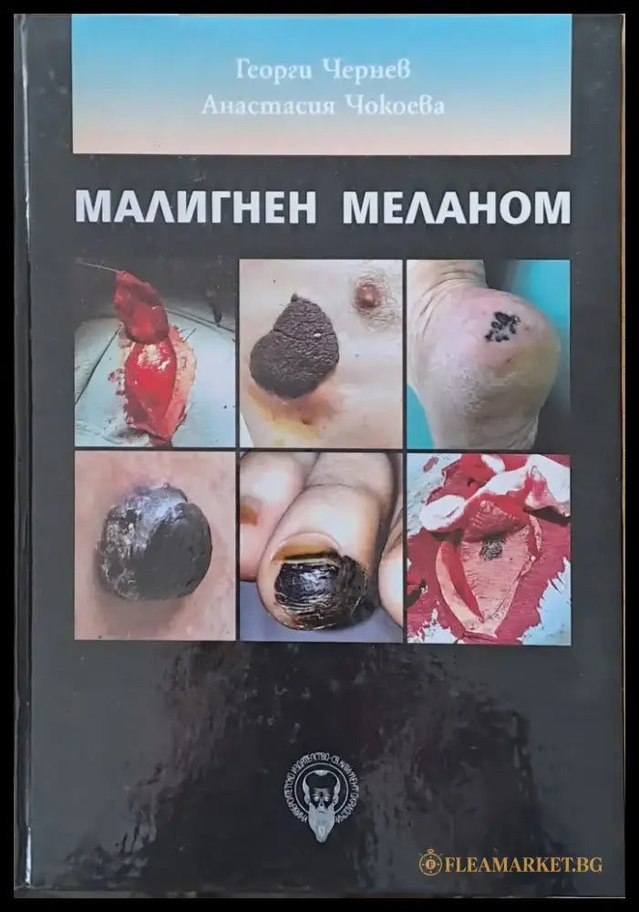 Малигнен меланом - Книги