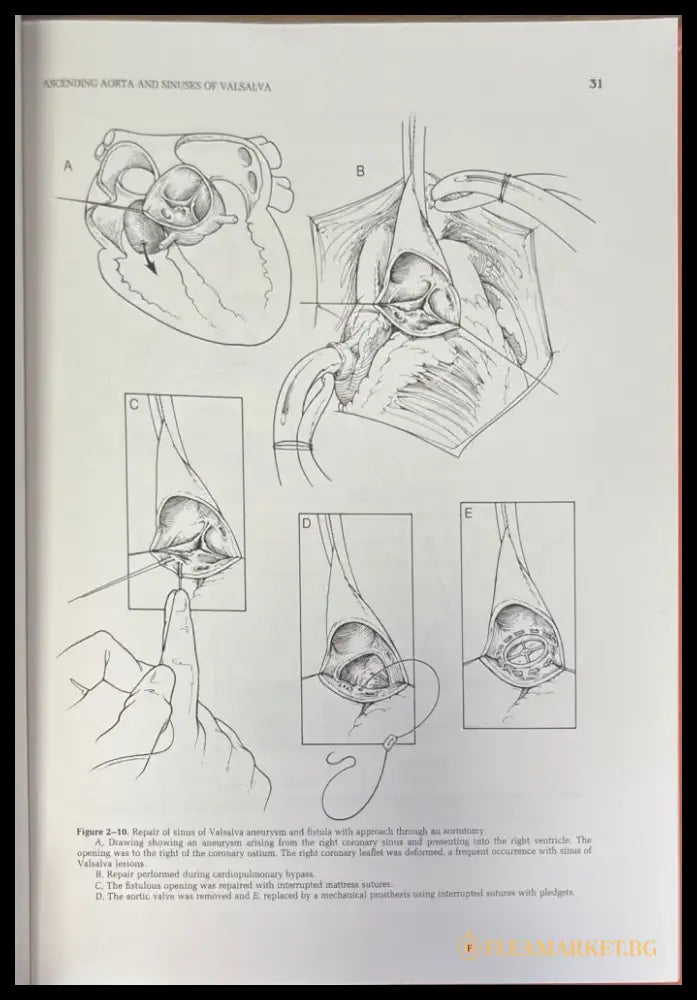 Surgical treatment of aortic aneurysms - Книги